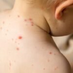 Salud confirma dos casos de sarampión y descarta contagio en el Liceo de Moravia